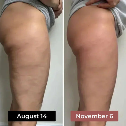Anti-cellulite leggings designed to show visible smoothing in as little as 14 days