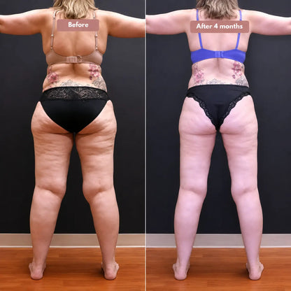 Cellumove USA 3D Legging – Say goodbye to lipoedema pain and swelling naturally