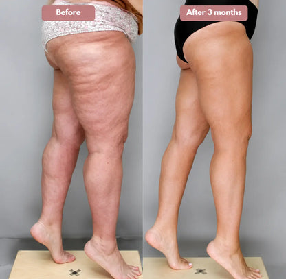 Cellumove USA 3D Legging – Say goodbye to lipoedema pain and swelling naturally