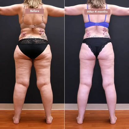 Cellumove USA 3D Legging – Say goodbye to lipoedema pain and swelling naturally.