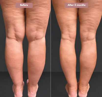 Cellumove USA 3D Legging – Say goodbye to lipoedema pain and swelling naturally